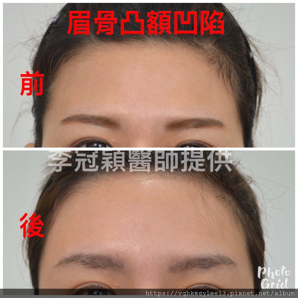 ABD47802-2983-4E96-847E-07D67B0AB7AC.jpg - 墊額頭