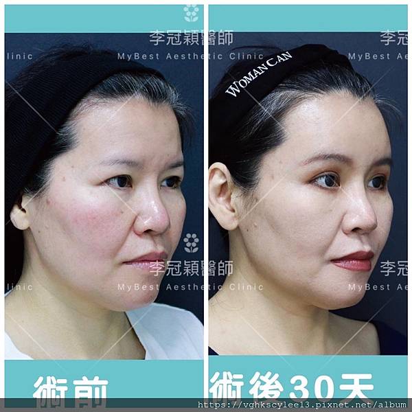 IMG_2765.JPG - 內視鏡提眉