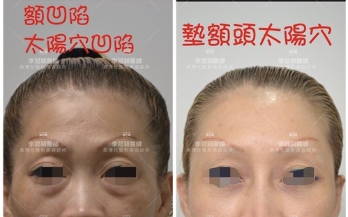 fullsizeoutput_417f.jpeg - 墊額頭