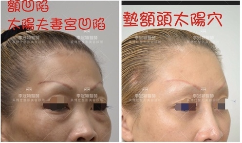 fullsizeoutput_4182.jpeg - 墊額頭