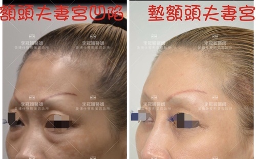 fullsizeoutput_4185.jpeg - 墊額頭