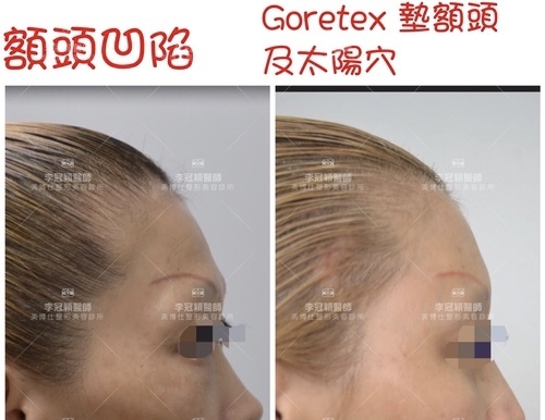 fullsizeoutput_4186.jpeg - 墊額頭