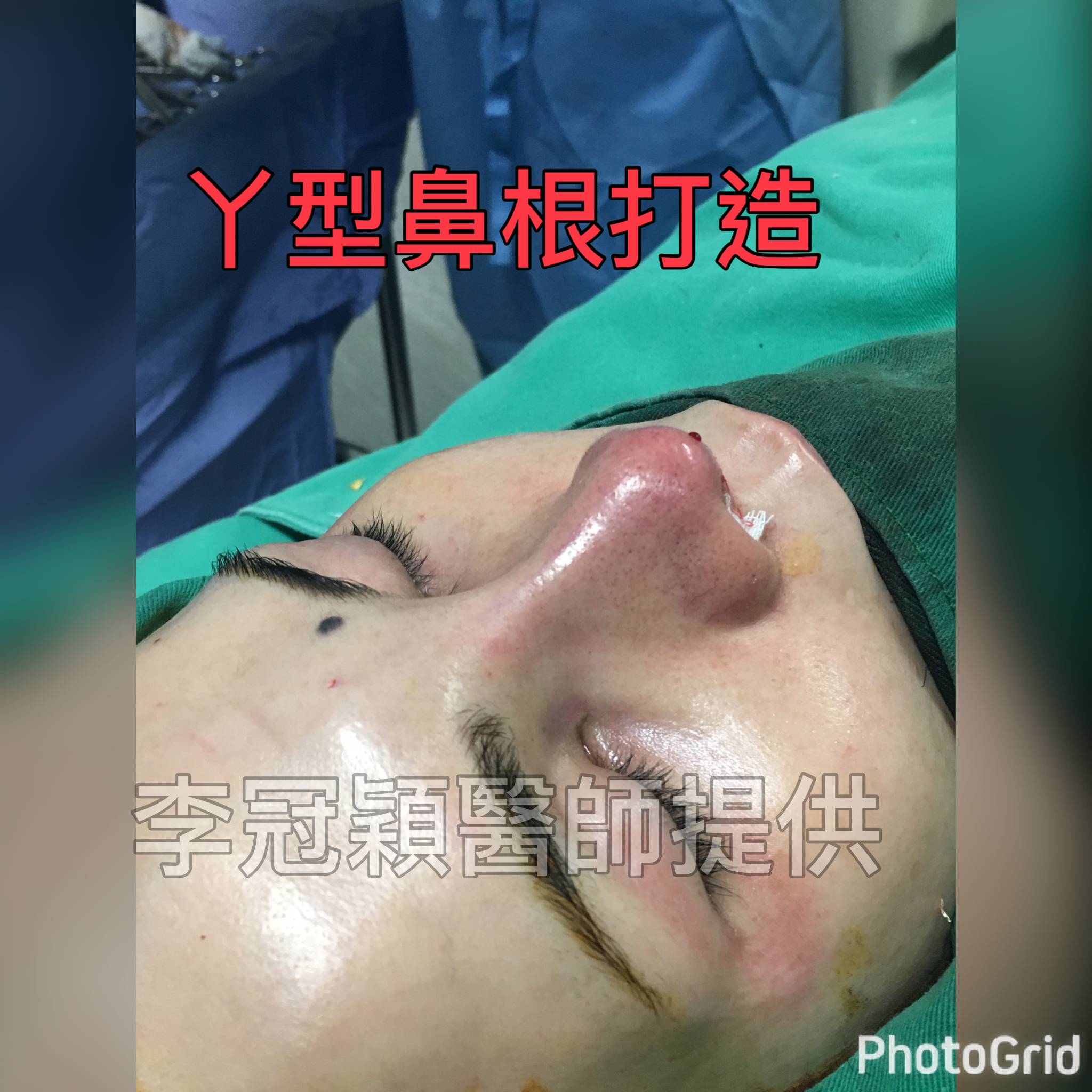 隆鼻最好材料? 誰不容易取出?誰會感染?誰會吸收變形?搶救 隆鼻最好材料? 誰不容易取出?誰會感染?誰會吸收變形?搶救