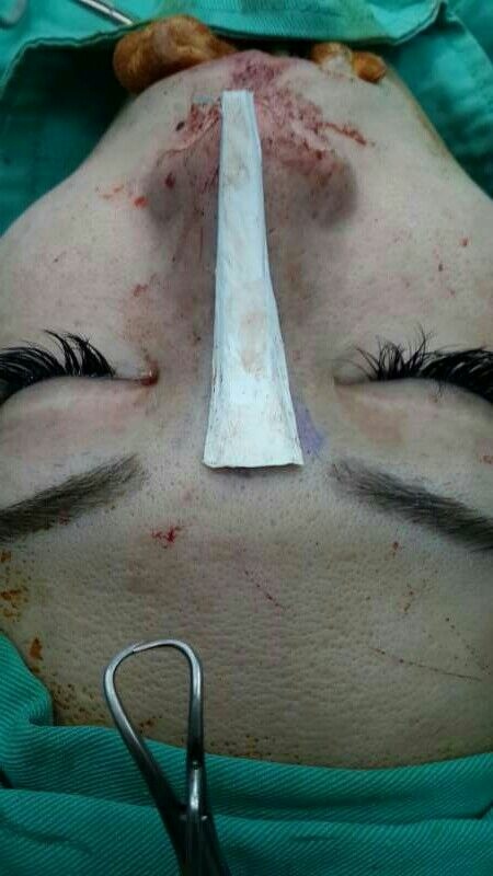 隆鼻最好材料? 誰不容易取出?誰會感染?誰會吸收變形?搶救 隆鼻最好材料? 誰不容易取出?誰會感染?誰會吸收變形?搶救