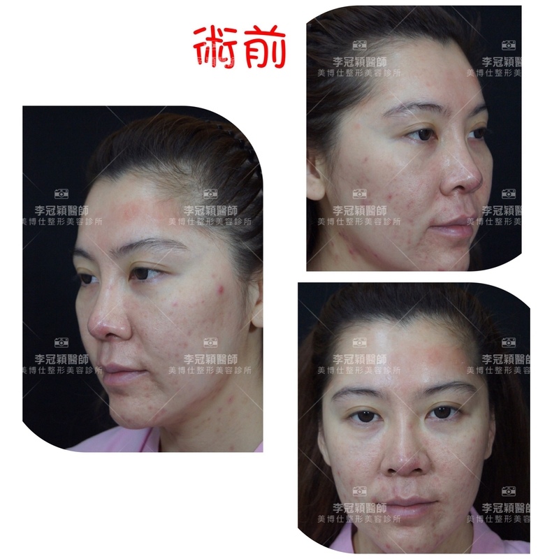 隆鼻最好材料? 誰不容易取出?誰會感染?誰會吸收變形?搶救 隆鼻最好材料? 誰不容易取出?誰會感染?誰會吸收變形?搶救