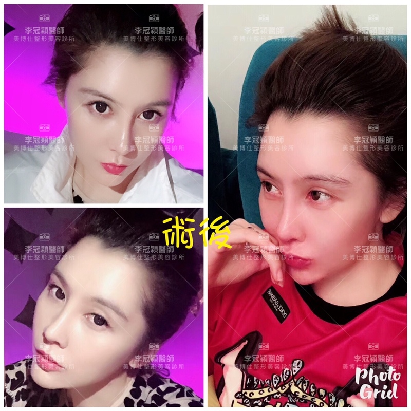 隆鼻最好材料? 誰不容易取出?誰會感染?誰會吸收變形?搶救 隆鼻最好材料? 誰不容易取出?誰會感染?誰會吸收變形?搶救