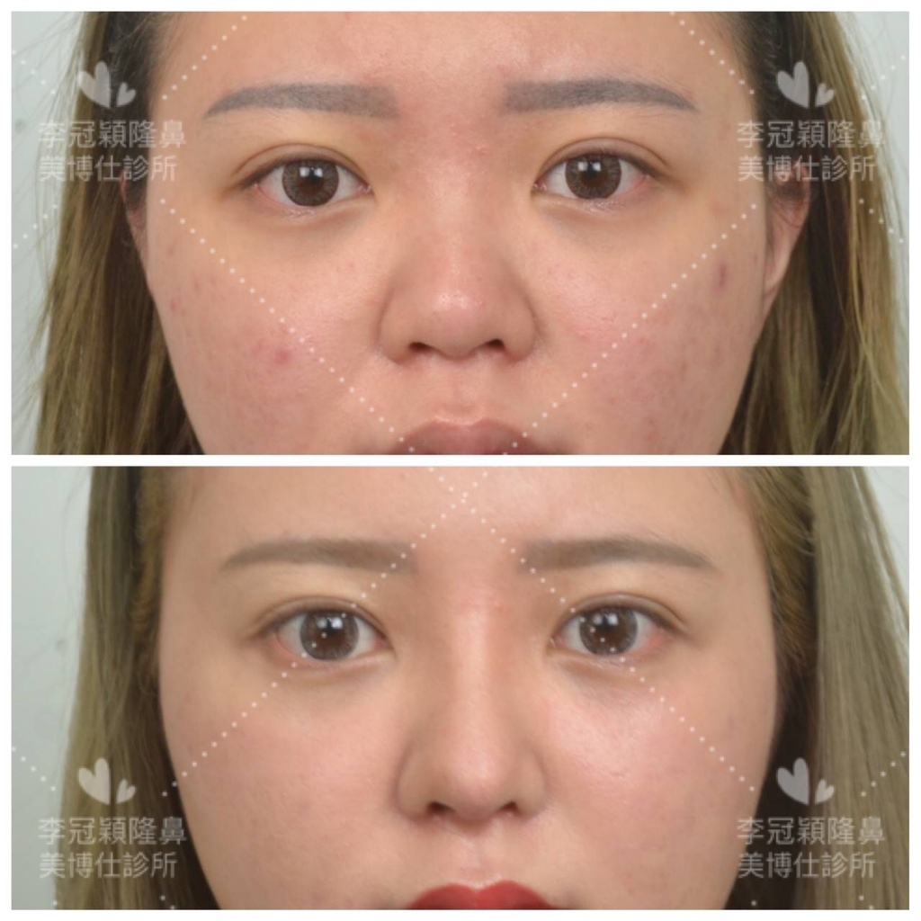 隆鼻最好材料? 誰不容易取出?誰會感染?誰會吸收變形?搶救 隆鼻最好材料? 誰不容易取出?誰會感染?誰會吸收變形?搶救