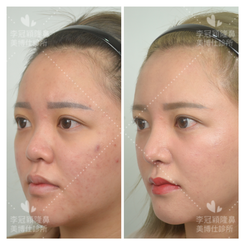 隆鼻最好材料? 誰不容易取出?誰會感染?誰會吸收變形?搶救 隆鼻最好材料? 誰不容易取出?誰會感染?誰會吸收變形?搶救