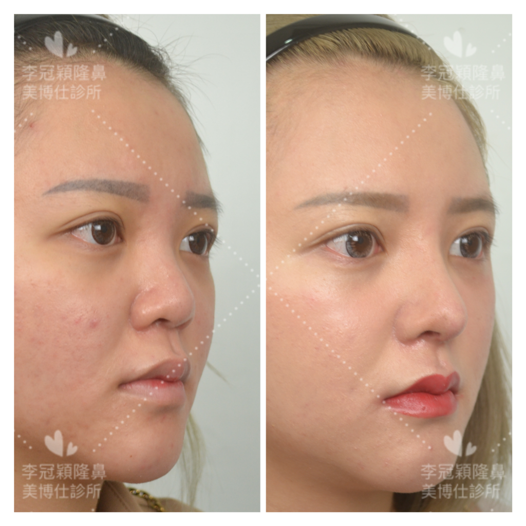 隆鼻最好材料? 誰不容易取出?誰會感染?誰會吸收變形?搶救 隆鼻最好材料? 誰不容易取出?誰會感染?誰會吸收變形?搶救