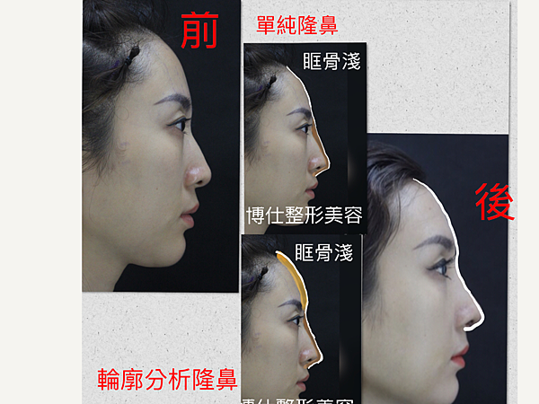 搶救失敗隆鼻三:沒有條件如何隆鼻?正解:輪廓解析隆鼻術(避免 搶救失敗隆鼻三:沒有條件如何隆鼻?正解:輪廓解析隆鼻術(避免