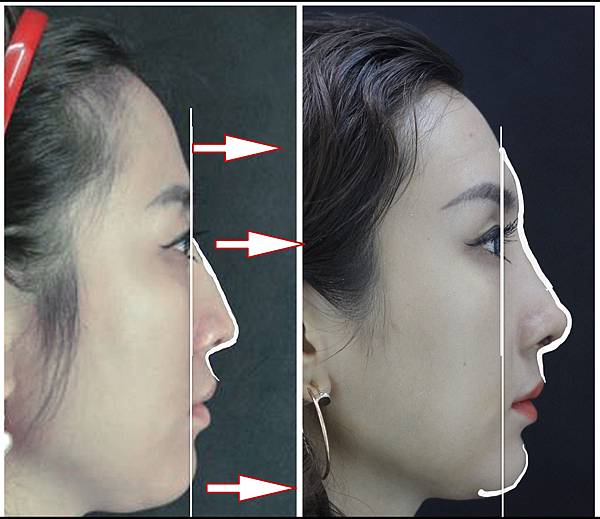 搶救失敗隆鼻三:沒有條件如何隆鼻?正解:輪廓解析隆鼻術(避免 搶救失敗隆鼻三:沒有條件如何隆鼻?正解:輪廓解析隆鼻術(避免