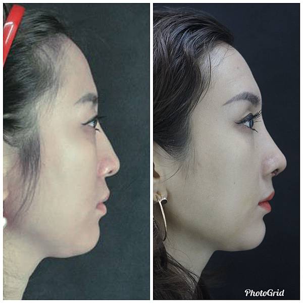 搶救失敗隆鼻三:沒有條件如何隆鼻?正解:輪廓解析隆鼻術(避免 搶救失敗隆鼻三:沒有條件如何隆鼻?正解:輪廓解析隆鼻術(避免