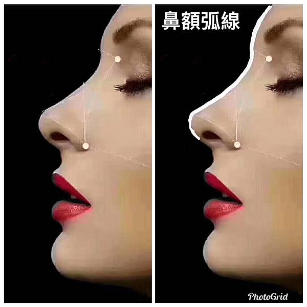 搶救失敗隆鼻三:沒有條件如何隆鼻?正解:輪廓解析隆鼻術(避免 搶救失敗隆鼻三:沒有條件如何隆鼻?正解:輪廓解析隆鼻術(避免