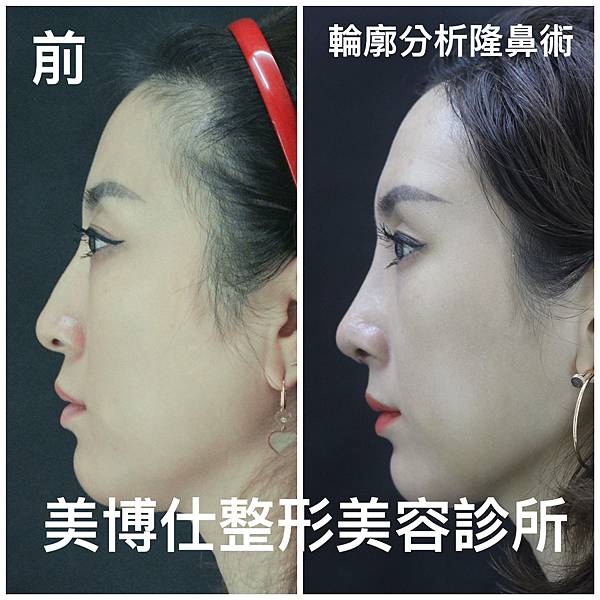 搶救失敗隆鼻三:沒有條件如何隆鼻?正解:輪廓解析隆鼻術(避免 搶救失敗隆鼻三:沒有條件如何隆鼻?正解:輪廓解析隆鼻術(避免