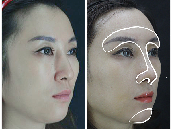 搶救失敗隆鼻三:沒有條件如何隆鼻?正解:輪廓解析隆鼻術(避免 搶救失敗隆鼻三:沒有條件如何隆鼻?正解:輪廓解析隆鼻術(避免