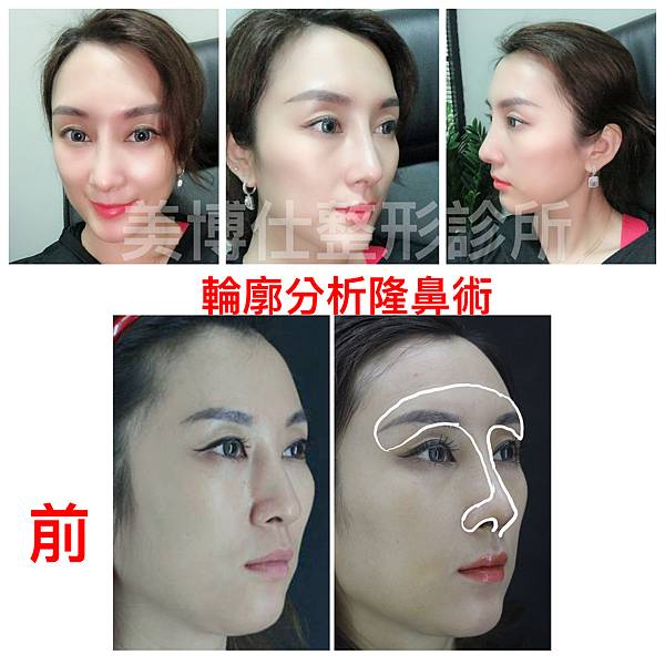 搶救失敗隆鼻三:沒有條件如何隆鼻?正解:輪廓解析隆鼻術(避免 搶救失敗隆鼻三:沒有條件如何隆鼻?正解:輪廓解析隆鼻術(避免