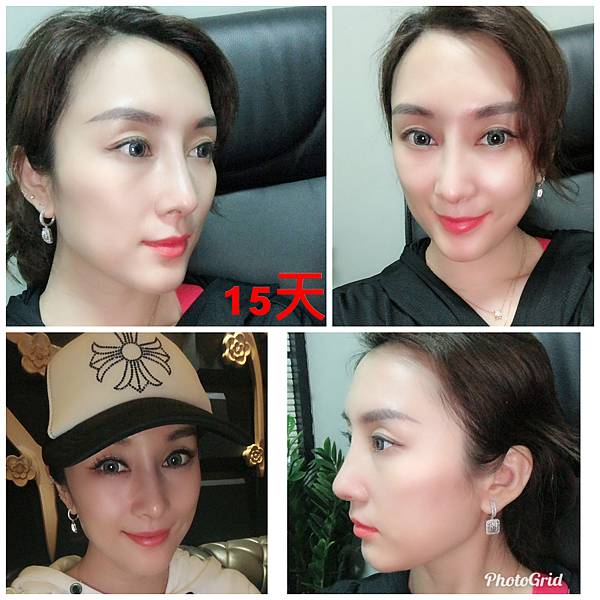 搶救失敗隆鼻三:沒有條件如何隆鼻?正解:輪廓解析隆鼻術(避免 搶救失敗隆鼻三:沒有條件如何隆鼻?正解:輪廓解析隆鼻術(避免