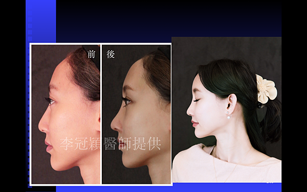 搶救失敗隆鼻三:沒有條件如何隆鼻?正解:輪廓解析隆鼻術(避免 搶救失敗隆鼻三:沒有條件如何隆鼻?正解:輪廓解析隆鼻術(避免