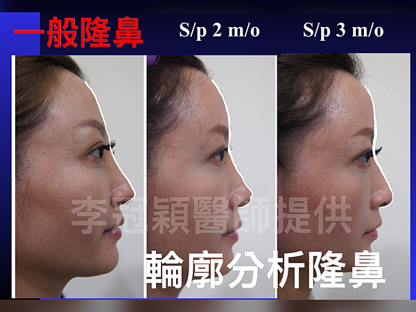 搶救失敗隆鼻三:沒有條件如何隆鼻?正解:輪廓解析隆鼻術(避免 搶救失敗隆鼻三:沒有條件如何隆鼻?正解:輪廓解析隆鼻術(避免