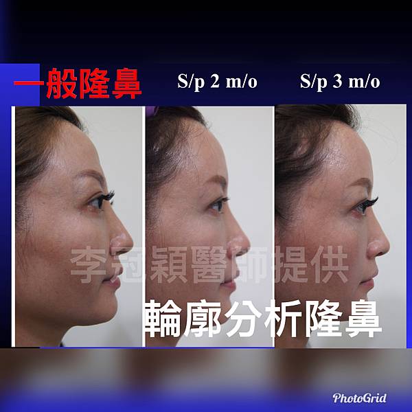 搶救失敗隆鼻三:沒有條件如何隆鼻?正解:輪廓解析隆鼻術(避免 搶救失敗隆鼻三:沒有條件如何隆鼻?正解:輪廓解析隆鼻術(避免