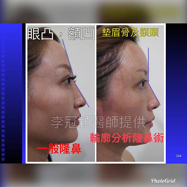 搶救失敗隆鼻三:沒有條件如何隆鼻?正解:輪廓解析隆鼻術(避免 搶救失敗隆鼻三:沒有條件如何隆鼻?正解:輪廓解析隆鼻術(避免