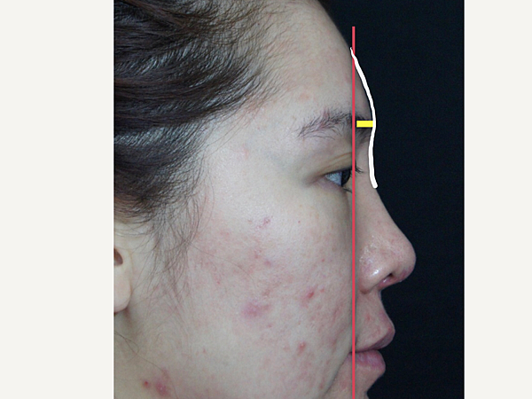 搶救失敗隆鼻三:沒有條件如何隆鼻?正解:輪廓解析隆鼻術(避免 搶救失敗隆鼻三:沒有條件如何隆鼻?正解:輪廓解析隆鼻術(避免