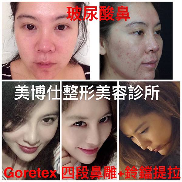 搶救失敗隆鼻三:沒有條件如何隆鼻?正解:輪廓解析隆鼻術(避免 搶救失敗隆鼻三:沒有條件如何隆鼻?正解:輪廓解析隆鼻術(避免