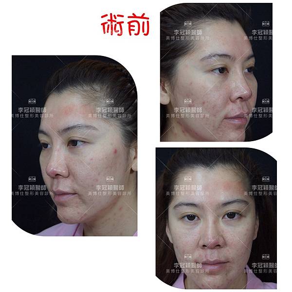 搶救失敗隆鼻三:沒有條件如何隆鼻?正解:輪廓解析隆鼻術(避免 搶救失敗隆鼻三:沒有條件如何隆鼻?正解:輪廓解析隆鼻術(避免