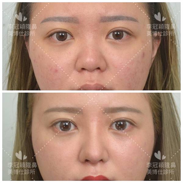 搶救失敗隆鼻三:沒有條件如何隆鼻?正解:輪廓解析隆鼻術(避免 搶救失敗隆鼻三:沒有條件如何隆鼻?正解:輪廓解析隆鼻術(避免