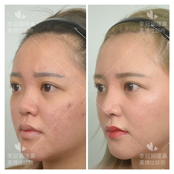 搶救失敗隆鼻三:沒有條件如何隆鼻?正解:輪廓解析隆鼻術(避免 搶救失敗隆鼻三:沒有條件如何隆鼻?正解:輪廓解析隆鼻術(避免