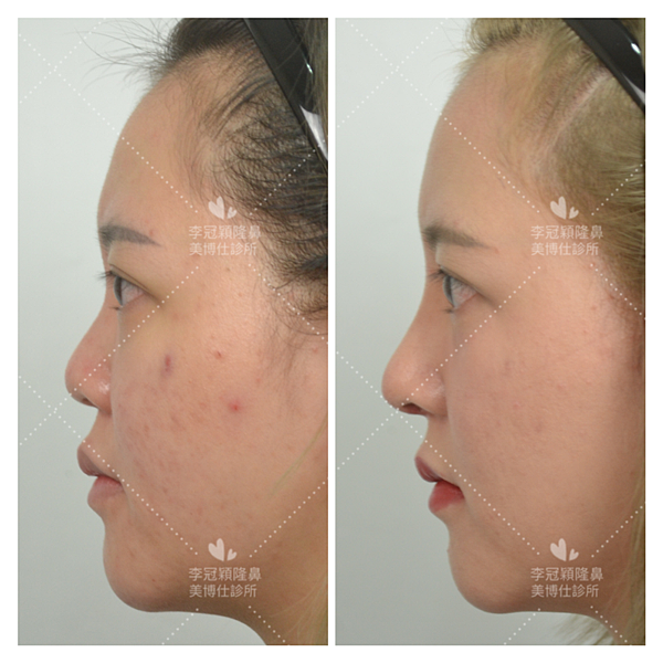 搶救失敗隆鼻三:沒有條件如何隆鼻?正解:輪廓解析隆鼻術(避免 搶救失敗隆鼻三:沒有條件如何隆鼻?正解:輪廓解析隆鼻術(避免