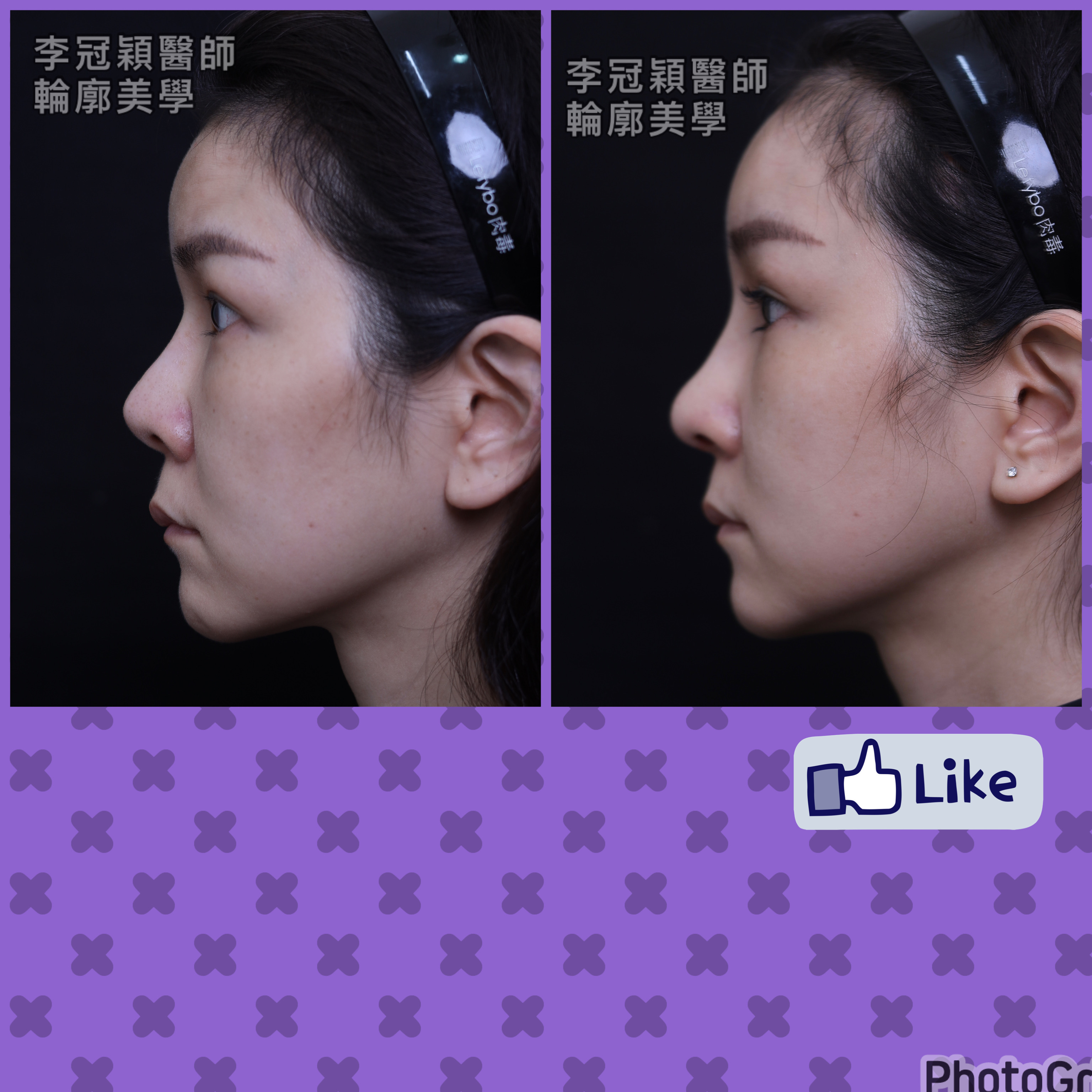 隆鼻最好材料? 誰不容易取出?誰會感染?誰會吸收變形?搶救 隆鼻最好材料? 誰不容易取出?誰會感染?誰會吸收變形?搶救