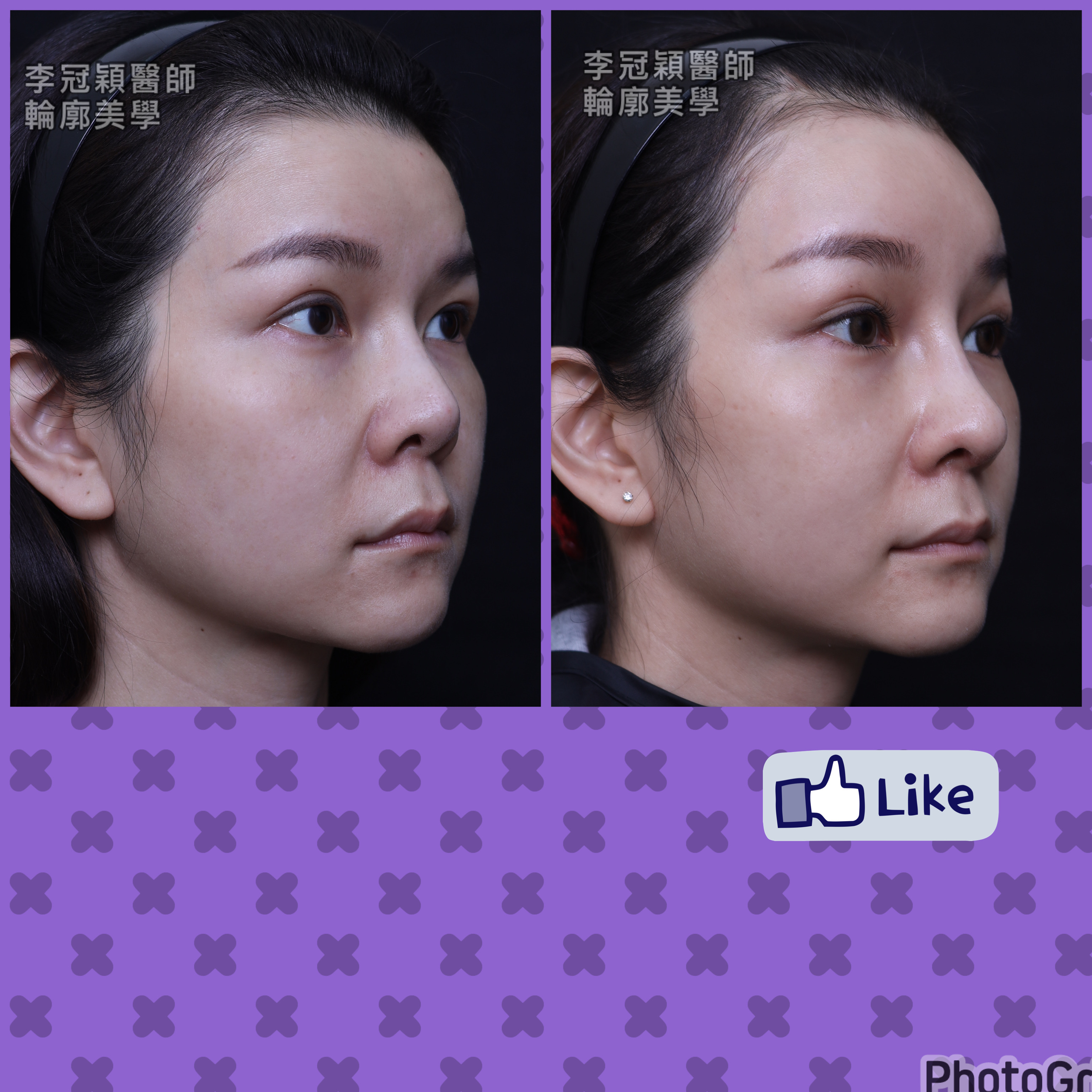 隆鼻最好材料? 誰不容易取出?誰會感染?誰會吸收變形?搶救 隆鼻最好材料? 誰不容易取出?誰會感染?誰會吸收變形?搶救