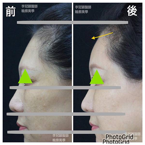 五爪提眉拉皮髮際線會後移嗎?怎麼辦? 五爪提眉拉皮髮際線會後移嗎?怎麼辦?