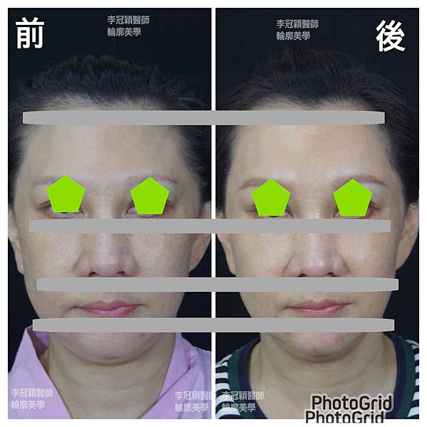 五爪提眉拉皮髮際線會後移嗎?怎麼辦? 五爪提眉拉皮髮際線會後移嗎?怎麼辦?