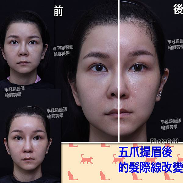 五爪提眉拉皮髮際線會後移嗎?怎麼辦? 五爪提眉拉皮髮際線會後移嗎?怎麼辦?