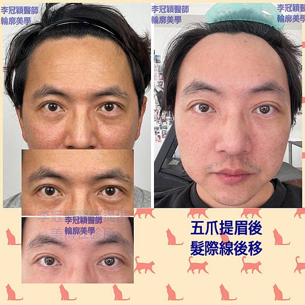 五爪提眉拉皮髮際線會後移嗎?怎麼辦? 五爪提眉拉皮髮際線會後移嗎?怎麼辦?