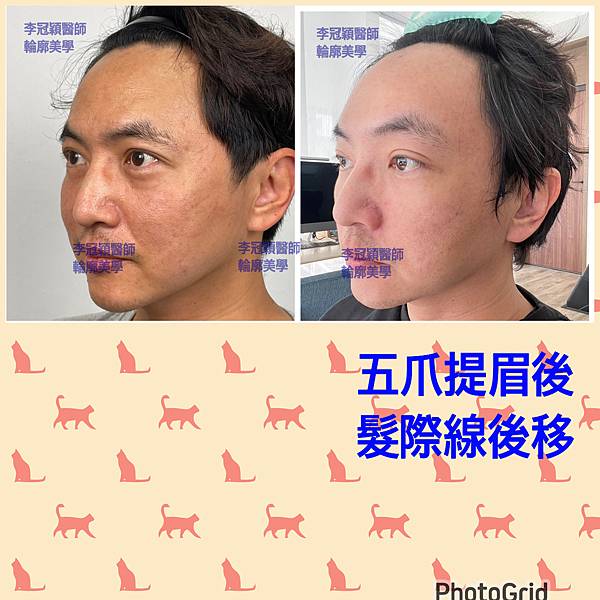 五爪提眉拉皮髮際線會後移嗎?怎麼辦? 五爪提眉拉皮髮際線會後移嗎?怎麼辦?