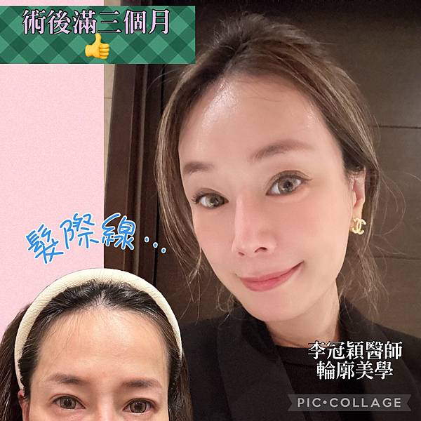 五爪提眉拉皮髮際線會後移嗎?怎麼辦? 五爪提眉拉皮髮際線會後移嗎?怎麼辦?