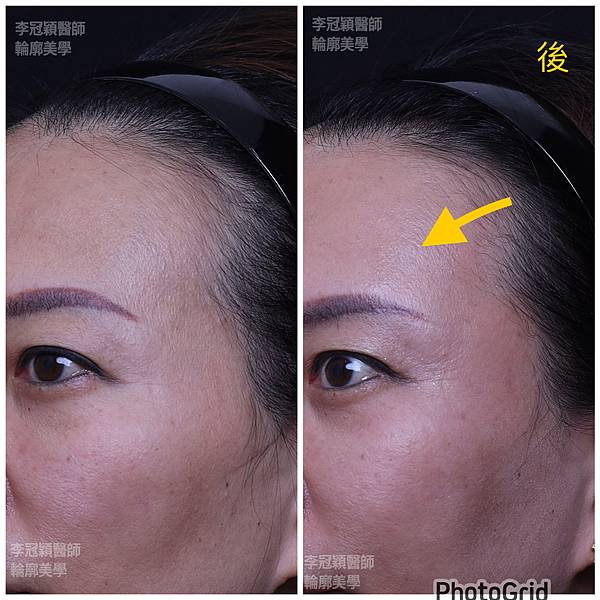 五爪提眉拉皮髮際線會後移嗎?怎麼辦? 五爪提眉拉皮髮際線會後移嗎?怎麼辦?