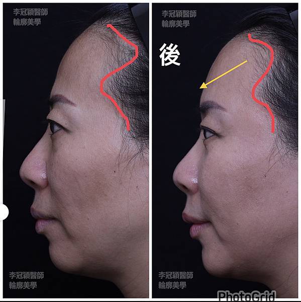 五爪提眉拉皮髮際線會後移嗎?怎麼辦? 五爪提眉拉皮髮際線會後移嗎?怎麼辦?