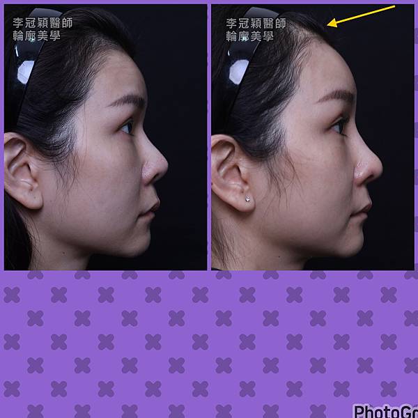 五爪提眉拉皮髮際線會後移嗎?怎麼辦? 五爪提眉拉皮髮際線會後移嗎?怎麼辦?