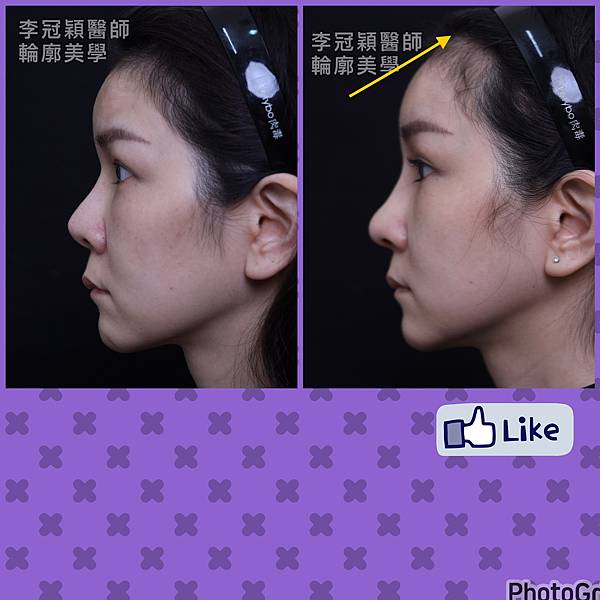 五爪提眉拉皮髮際線會後移嗎?怎麼辦? 五爪提眉拉皮髮際線會後移嗎?怎麼辦?