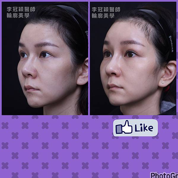 五爪提眉拉皮髮際線會後移嗎?怎麼辦? 五爪提眉拉皮髮際線會後移嗎?怎麼辦?