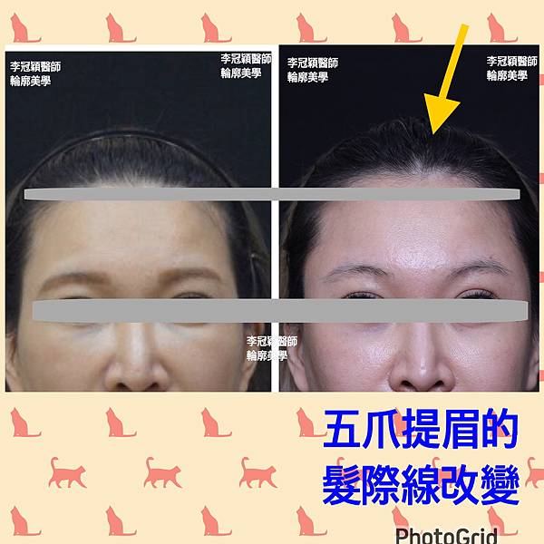 五爪提眉拉皮髮際線會後移嗎?怎麼辦? 五爪提眉拉皮髮際線會後移嗎?怎麼辦?