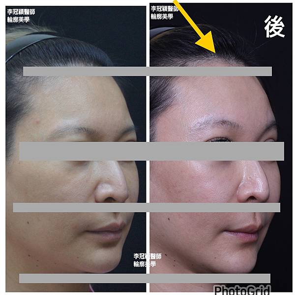 五爪提眉拉皮髮際線會後移嗎?怎麼辦? 五爪提眉拉皮髮際線會後移嗎?怎麼辦?