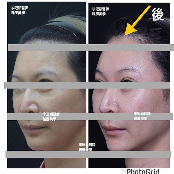 五爪提眉拉皮髮際線會後移嗎?怎麼辦? 五爪提眉拉皮髮際線會後移嗎?怎麼辦?