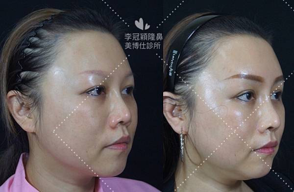 五爪提眉拉皮髮際線會後移嗎?怎麼辦? 五爪提眉拉皮髮際線會後移嗎?怎麼辦?