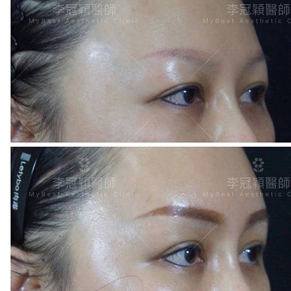 五爪提眉拉皮髮際線會後移嗎?怎麼辦? 五爪提眉拉皮髮際線會後移嗎?怎麼辦?