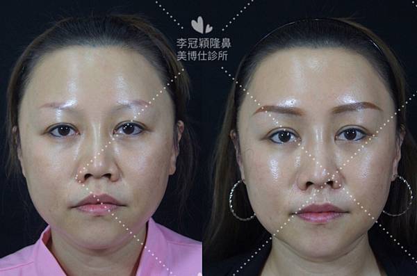 五爪提眉拉皮髮際線會後移嗎?怎麼辦? 五爪提眉拉皮髮際線會後移嗎?怎麼辦?